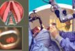 Laryngeal Frame Work Surgery