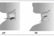 Laryngeal EMG