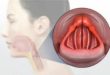 Laryngopharyngeal Reflux