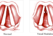 Vocal Cord Nodules