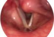 Vocal Cord Paralysis