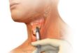 Vocal Fold Injections